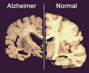 alzheimer_4