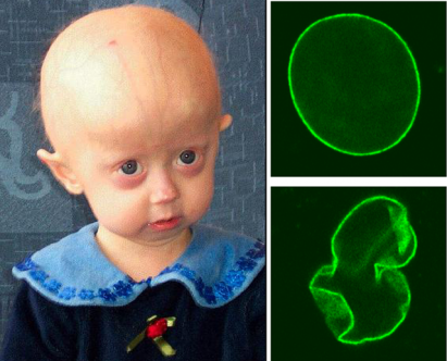 640px-Hutchinson-Gilford_Progeria_Syndrome