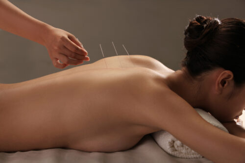 Doctor putting acupuncture needles on woman's shoulder,close-up