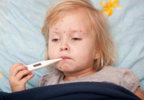 a-child-with-chicken-pox
