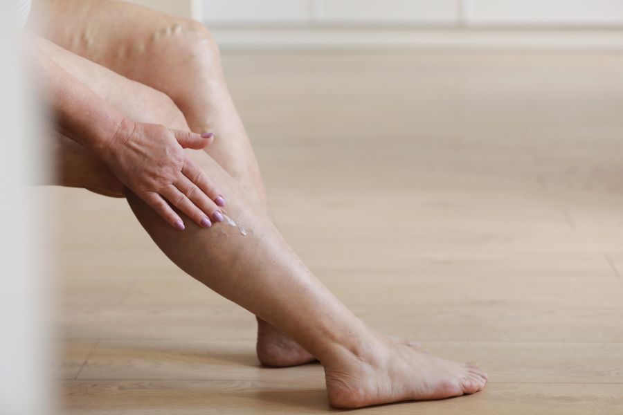 leczenie żylaków nóg