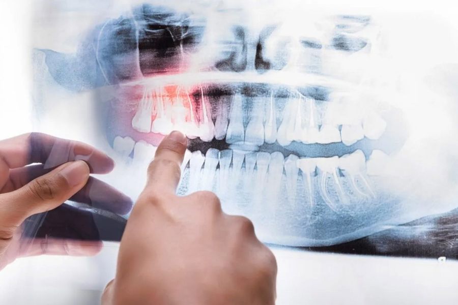 tomografia zębów