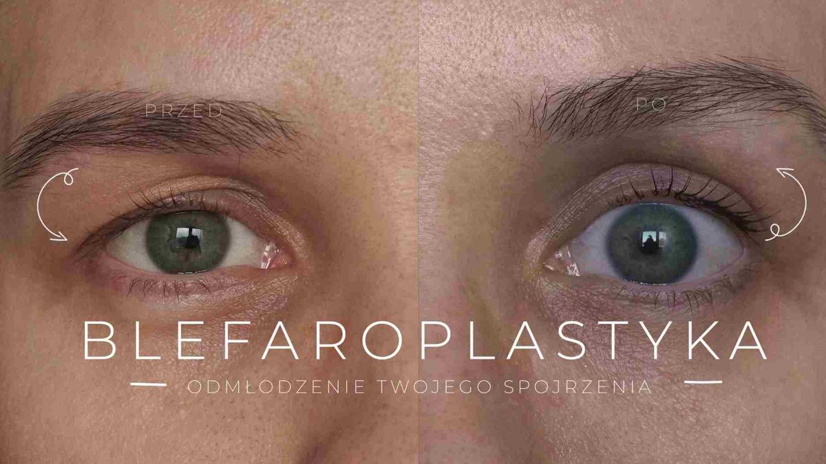 blefaroplastyka