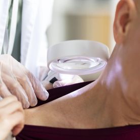 Badanie znamion w Krakowie – dermatoskopia i wideodermatoskopia. Dlaczego warto umówić się na kontrolę skóry?