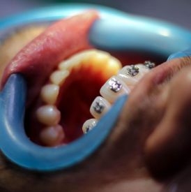 Czy aparat ortodontyczny po 30. roku życia ma sens?